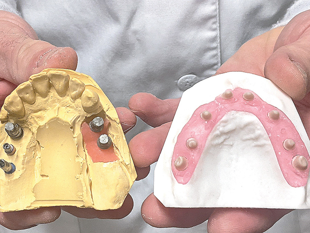 implant molds